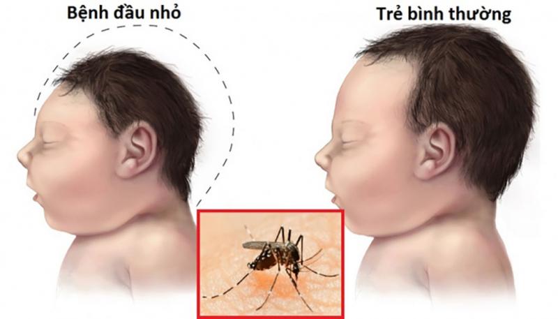 Muỗi lây truyền virus Zika gây hiện tượng đầu nhỏ ở trẻ - Nguồn Internet