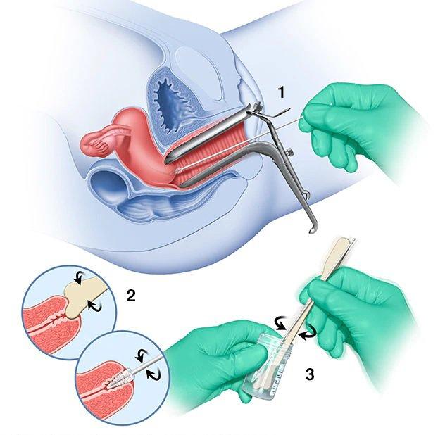 Quy trình lấy mẫu xét nghiệm PAP Smear