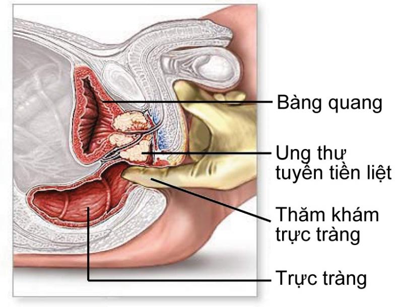 Sữa đậu nành ngăn ngừa bệnh về tuyến tiền liệt