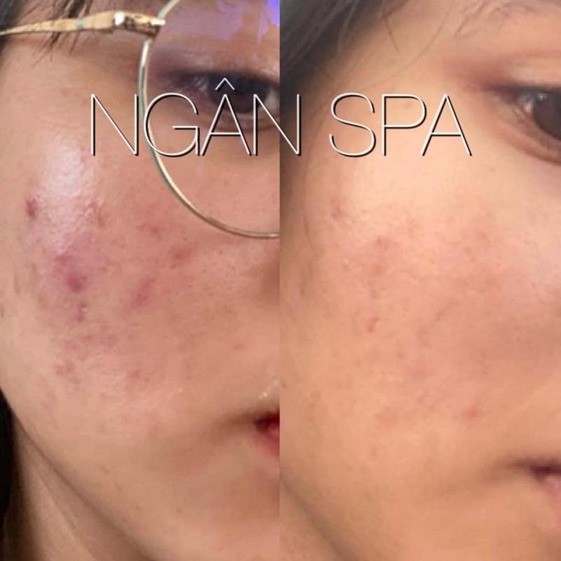 Ngân Spa Beauty & Clinic sẽ giải quyết những nỗi lo toan, phiền toái vì mụn của bạn với những kỹ thuật tiên tiến và phương pháp trị mụn chuẩn y khoa