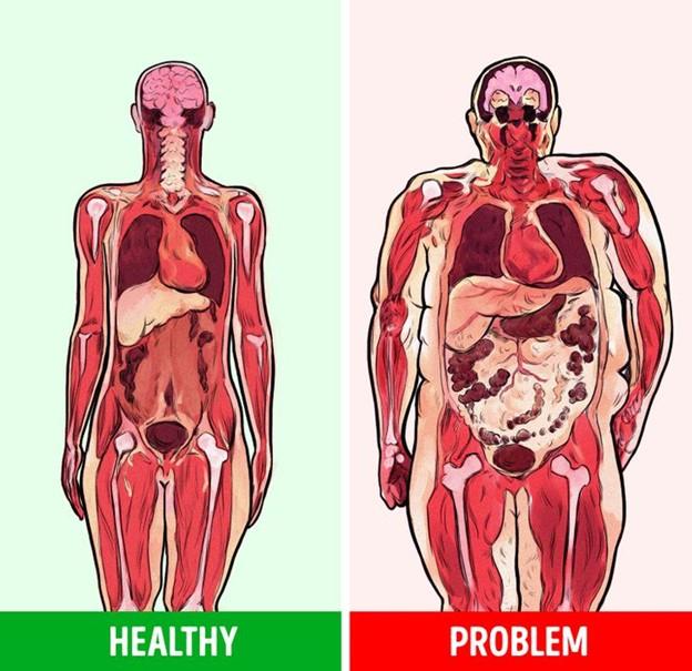 Nguy cơ mắc hội chứng chuyển hóa cao hơn