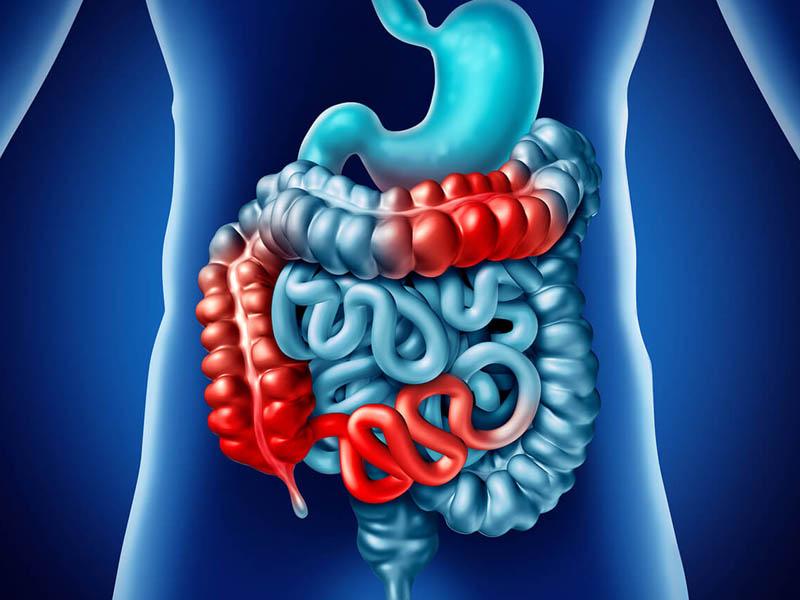 Nguyên nhân gây bệnh Crohn