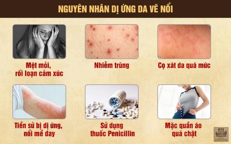 Top 8 Lưu ý quan trọng nhất về bệnh da vẽ nổi - toplist.vn