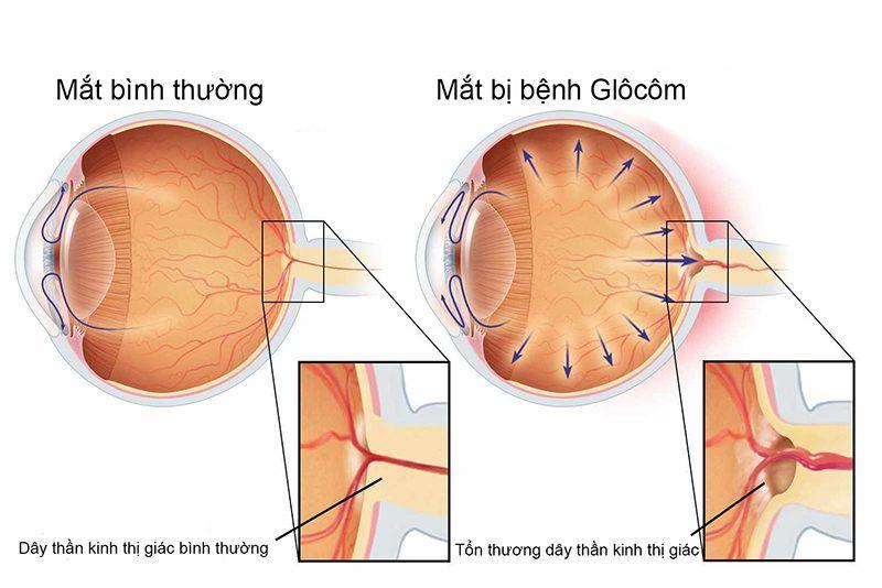 Nguyên nhân gây bệnh tăng nhãn áp