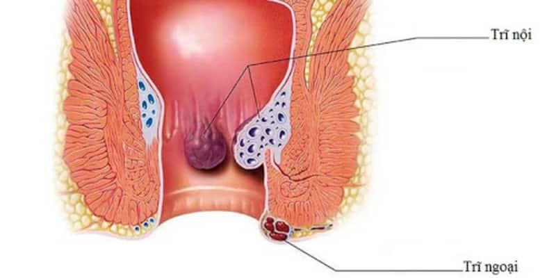 Nguyên nhân gây ra đại tiện ra máu