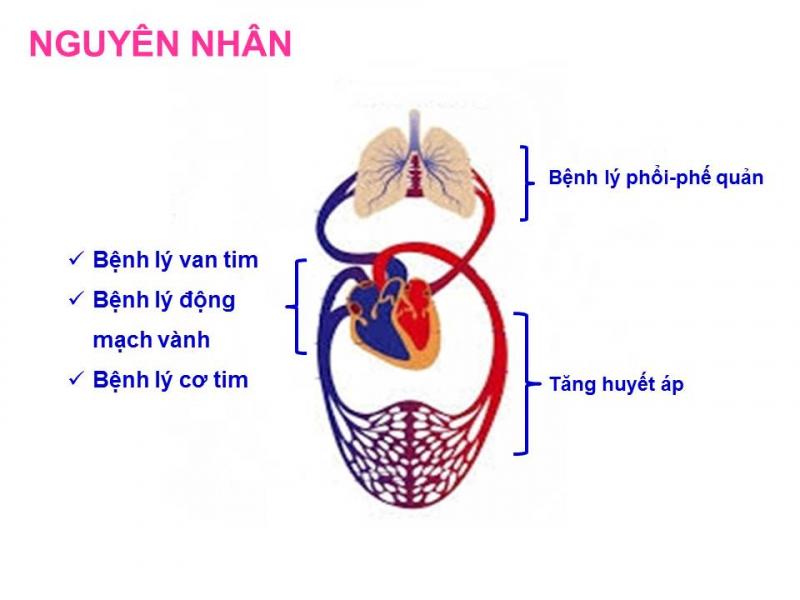 Nguyên nhân gây suy tim