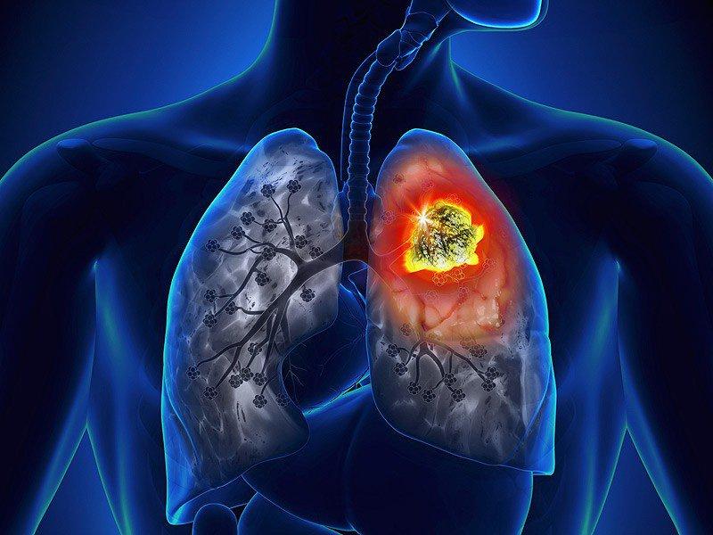 Ung thư phổi là một trong những nguyên nhân gây viêm màng phổi