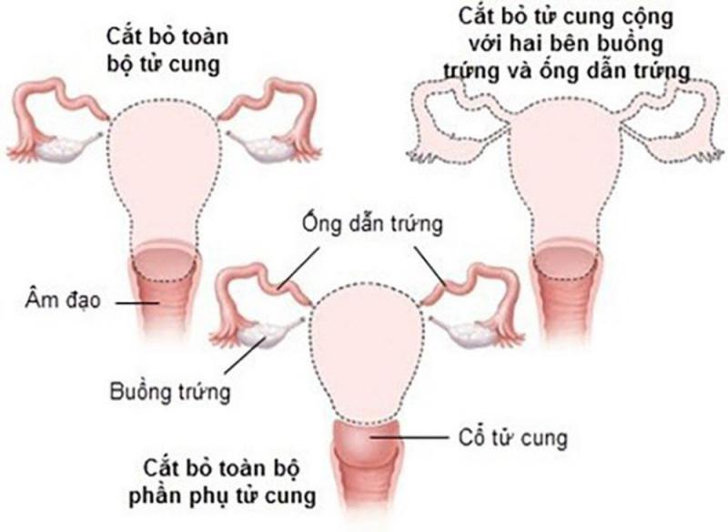 Cắt tử cung có thể gây bệnh sa bàng quang