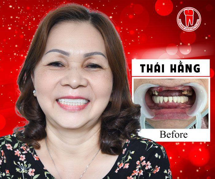 Khách hàng trồng răng Implant tại Đại Nam