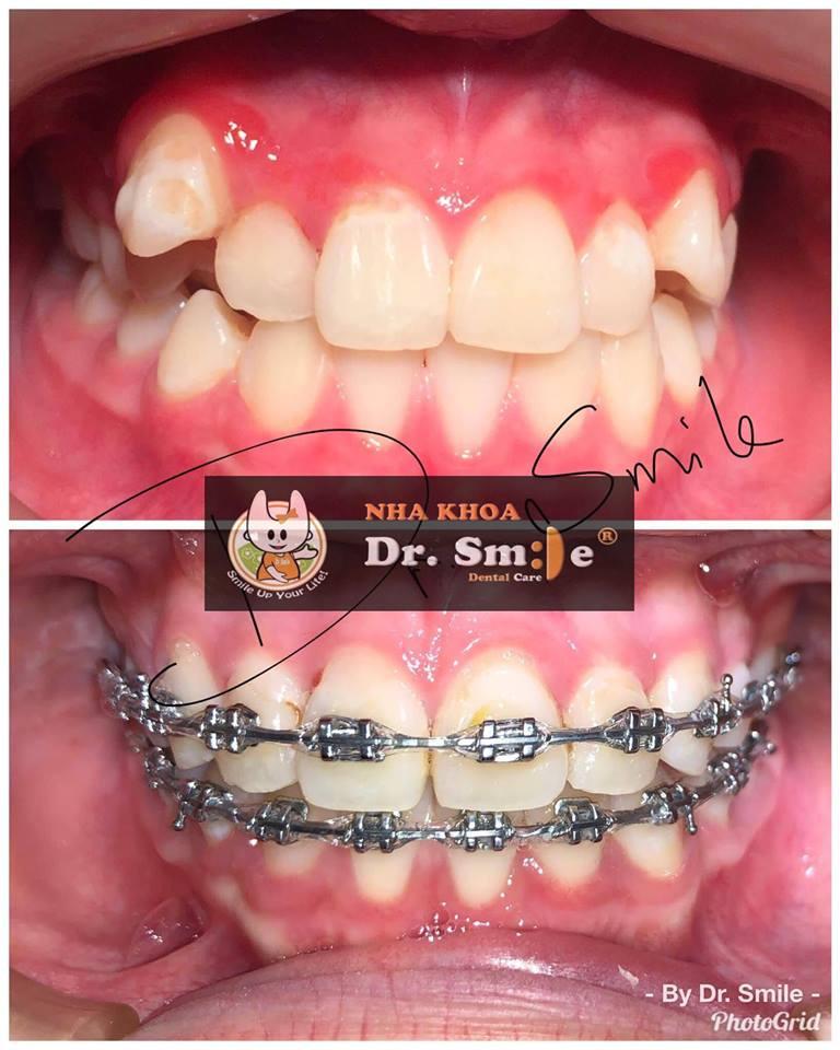 Niềng răng tại Nha khoa Dr. Smile