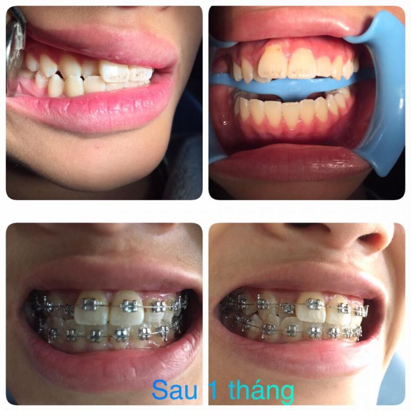 Hình ảnh răng sau niềng 1 tháng tại Dr.Cường