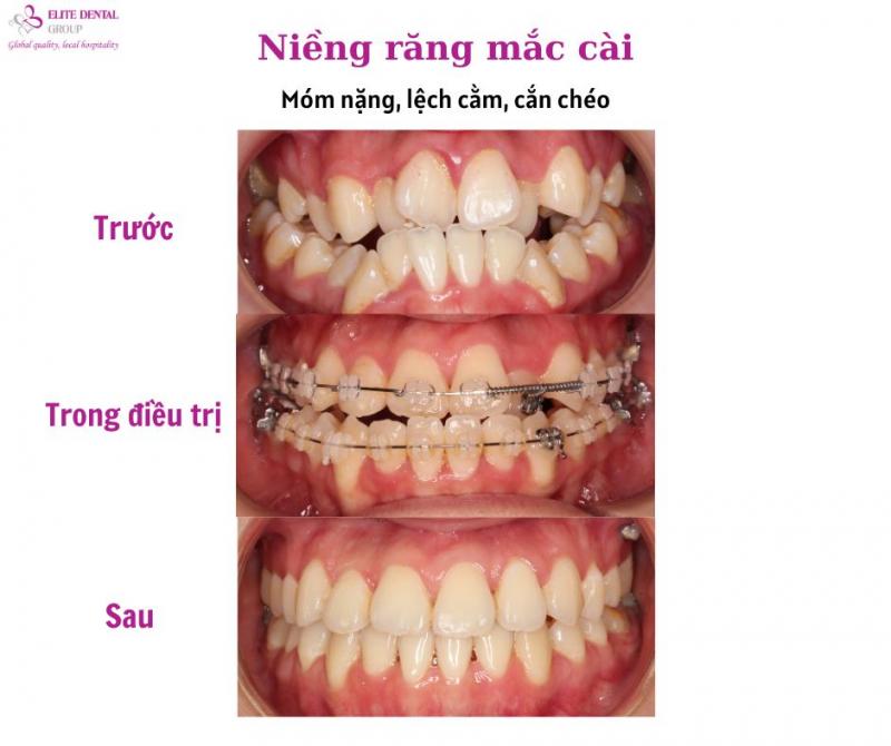 Nha khoa Elite Dental