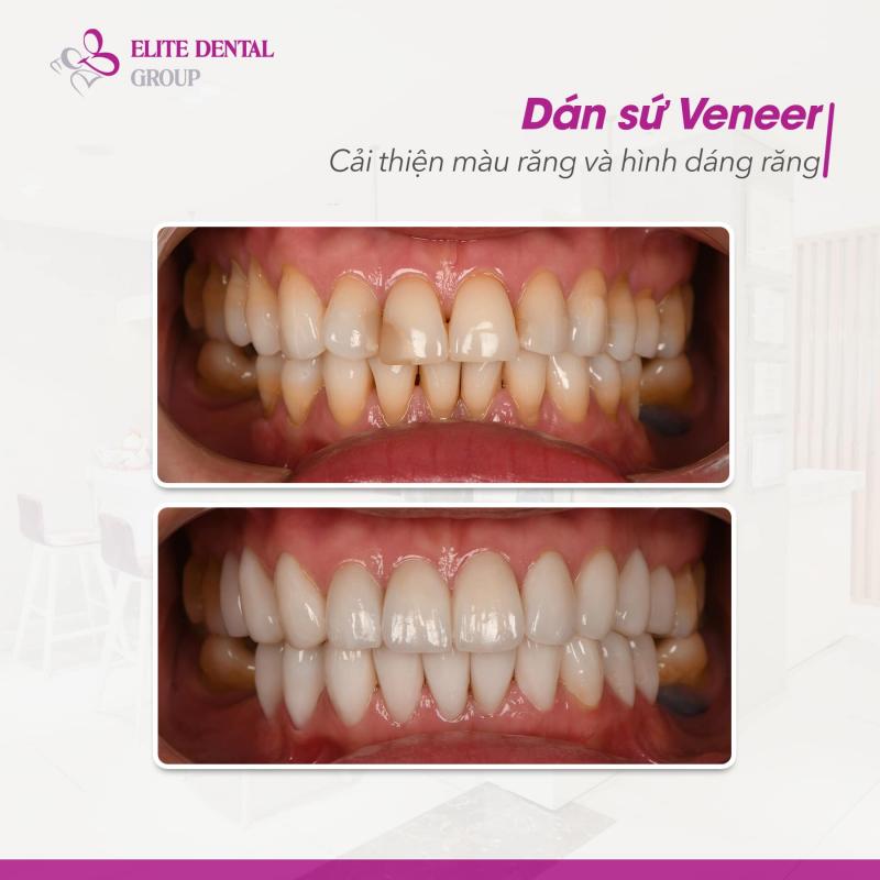 Nha khoa Elite Dental