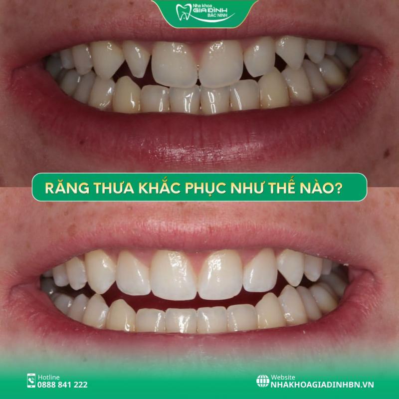 Nha Khoa Gia Đình Bắc Ninh