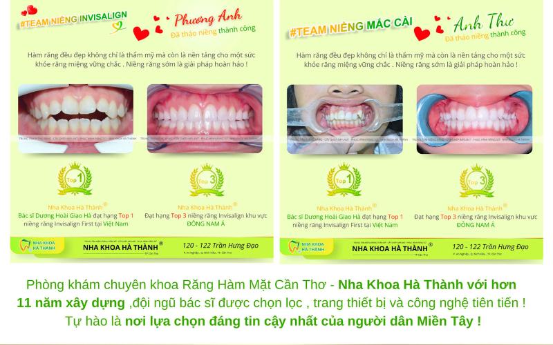 Nha Khoa Hà Thành - Địa Chỉ Niềng Răng Uy Tín Số 1 Cần Thơ