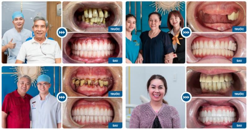 Các ca điều trị thực hiện thành công tại nha khoa I-Dent Gò Vấp