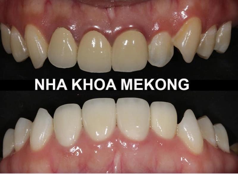 Nha Khoa Mekong là trung tâm cấy ghép implant, làm răng sứ thẩm mỹ với chất lượng vượt trội