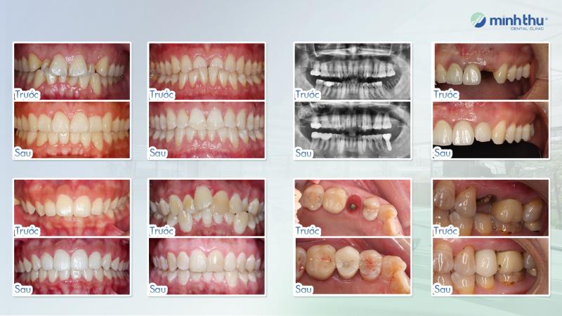 Các ca điều trị niềng kết thúc tại Minh Thu đều đạt được cả yếu tố thẩm mỹ, khả năng ăn nhai, khớp cắn đúng, và sự ổn định lâu dài cho bệnh nhân