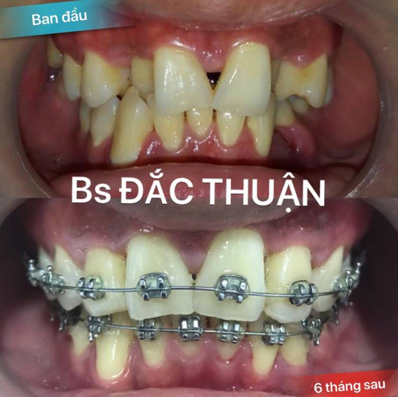 Niềng răng tại Nha khoa Nguyễn Đắc Cật - BS Đắc Thuận