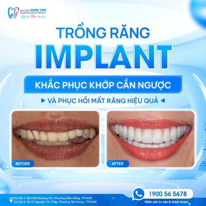 Nha khoa Nhân Tâm – Trung tâm cấy ghép Implant Việt Nam chuyên sâu