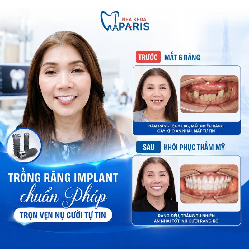 Hình ảnh khách hàng trồng răng Impland tại nha khoa Paris Đà Nẵng