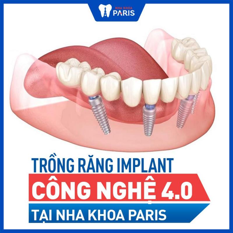 Top 8 địa chỉ trồng răng implant tốt nhất tại Đà Nẵng - Toplist.vn