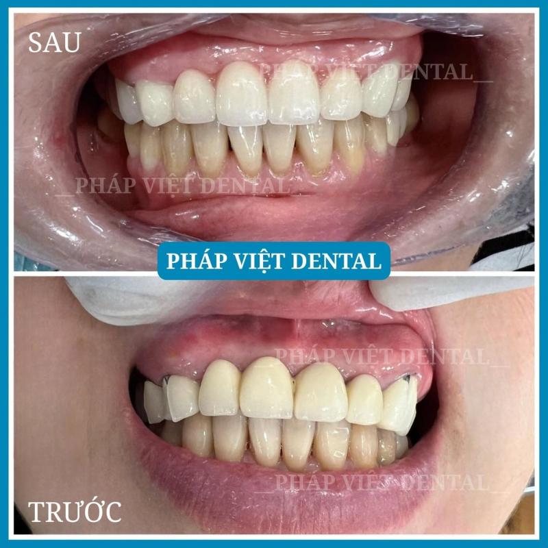 Nha khoa Pháp Việt Bình Dương