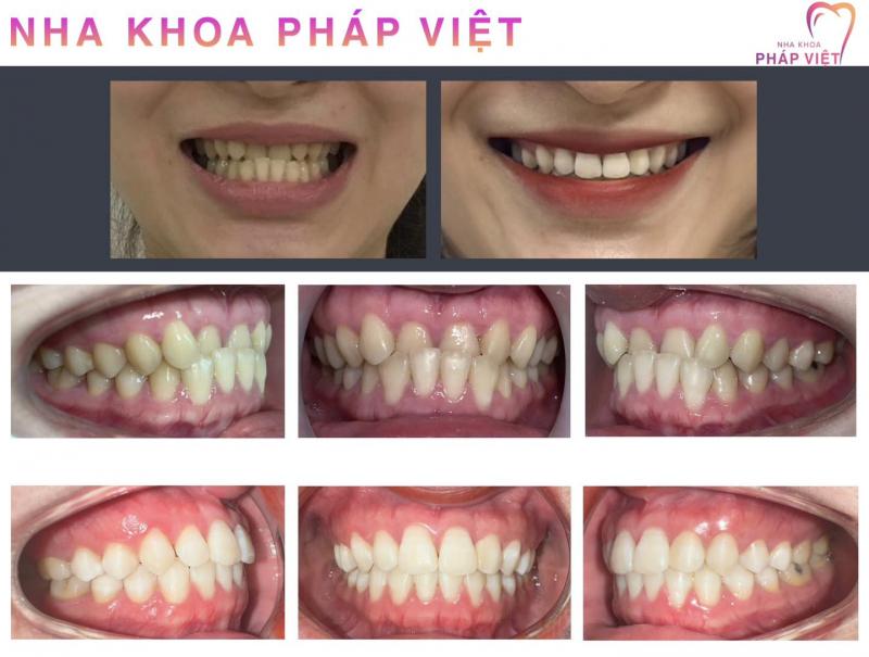 Nha Khoa Pháp Việt Huế