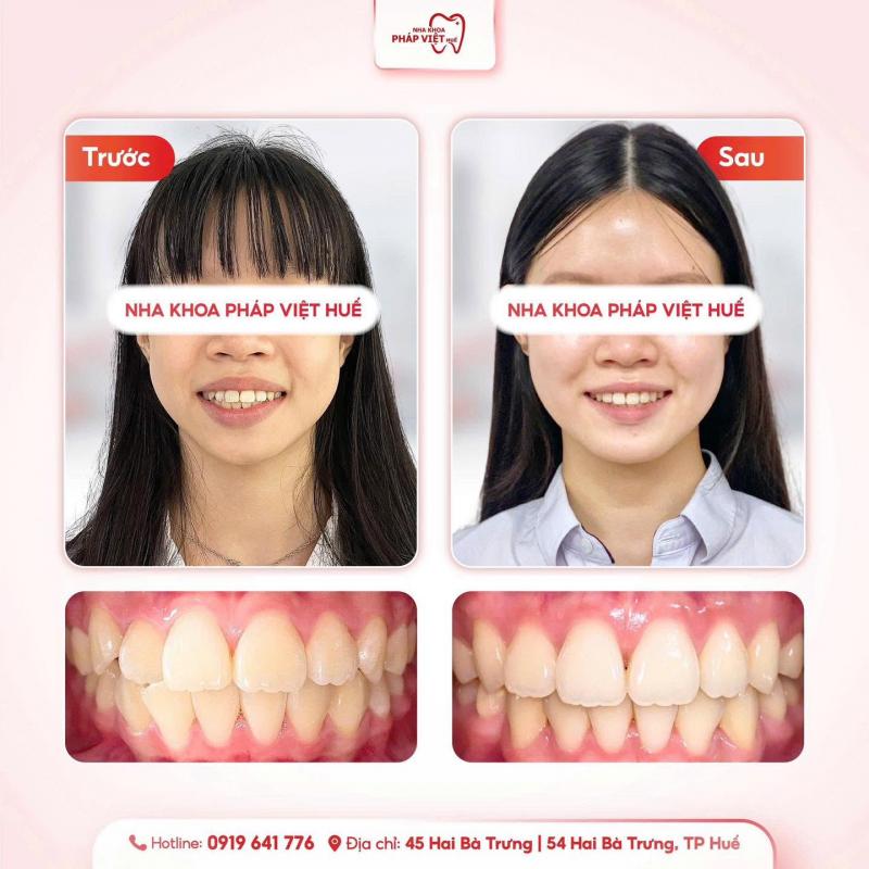 Nha Khoa Pháp Việt Huế