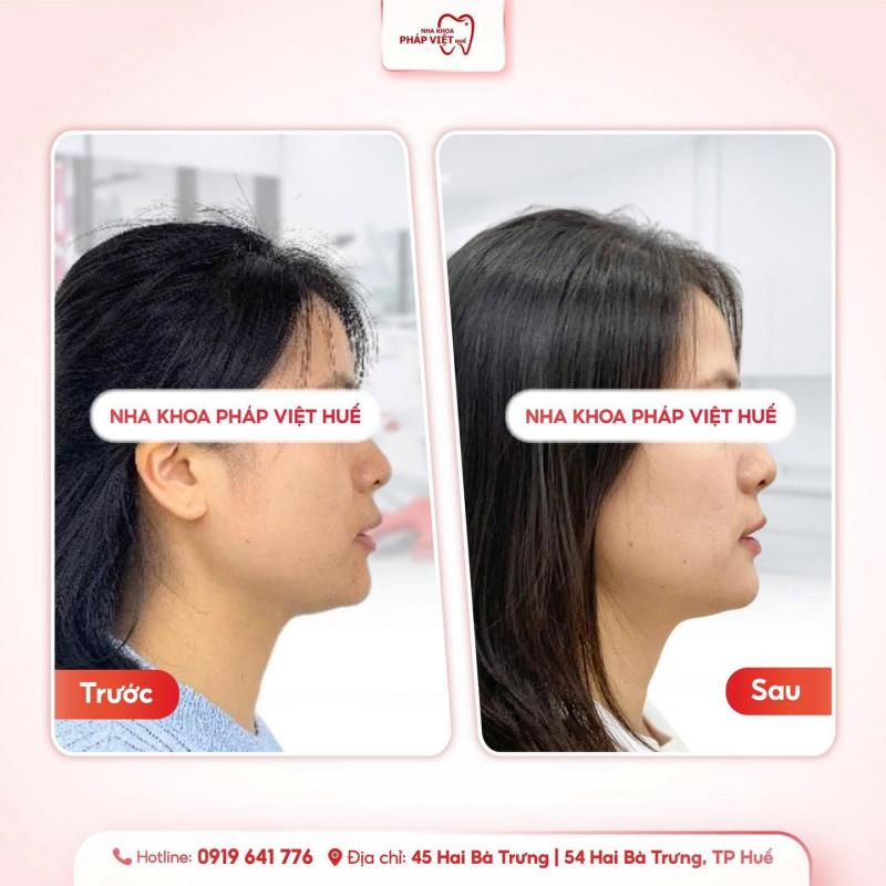 Nha Khoa Pháp Việt Huế
