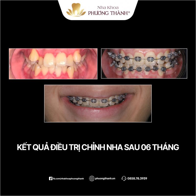 Kết quả chỉnh nha Nha khoa Phương Thành