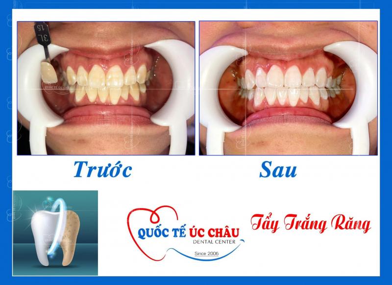 Nha Khoa Quốc Tế Úc Châu