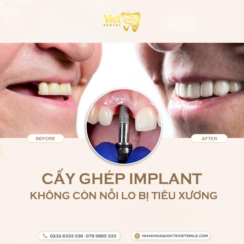 Nha Khoa Quốc Tế Việt Smile