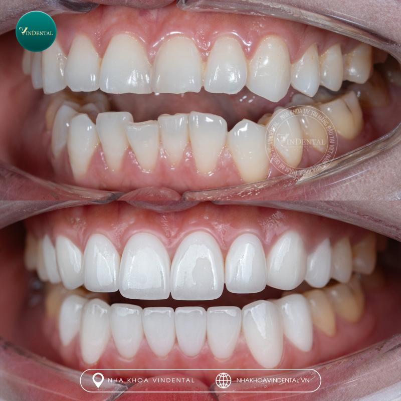 Nha Khoa Quốc Tế Vindental