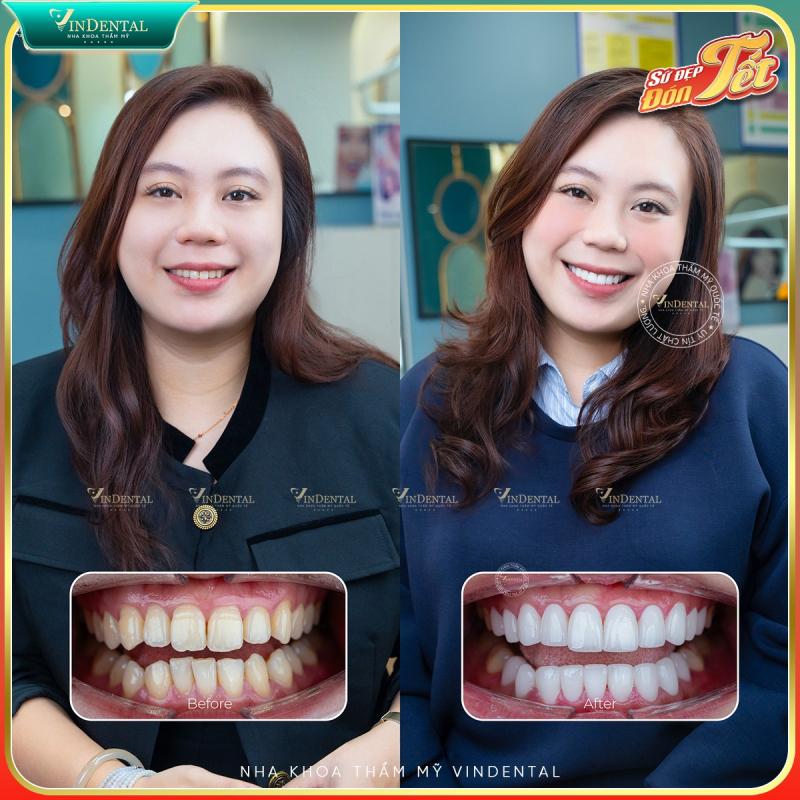 Nha Khoa Quốc Tế Vindental