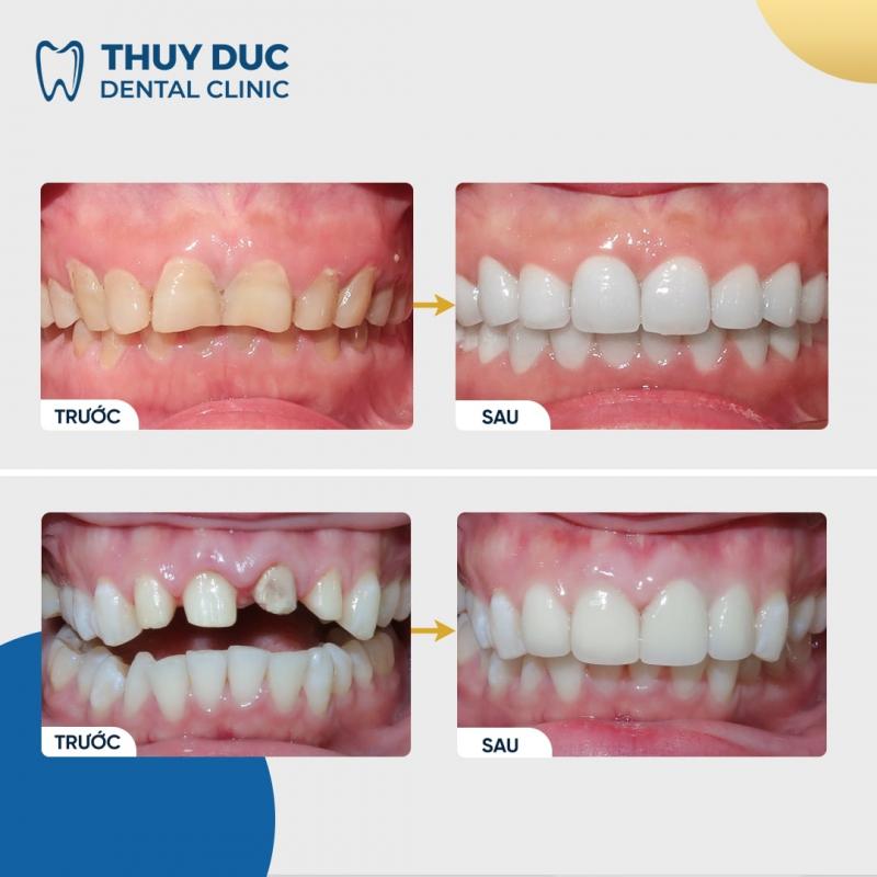 Dịch vụ bọc răng sứ tại Nha khoa Thuý Đức không chỉ theo đuổi mục tiêu thẩm mỹ mà còn ưu tiên vấn đề sức khoẻ của khách hàng