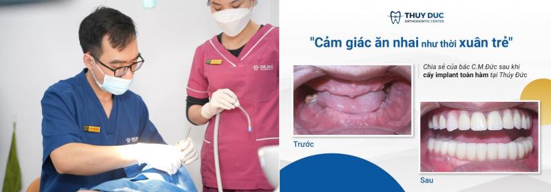 Bác sĩ Nguyễn Thanh Tuấn - Nha khoa Thúy Đức với gần 10 năm kinh nghiệm, trực tiếp thực hiện hơn 500 ca cấy ghép Implant/năm