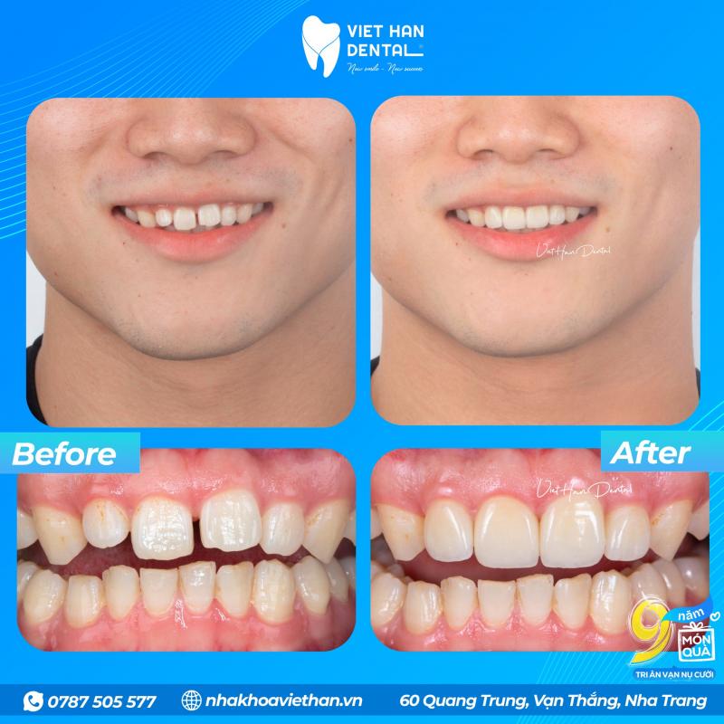 Nha Khoa Việt Hàn Nha Trang