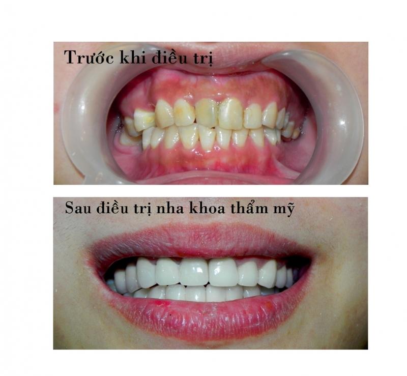 Trước và sau khi điều trị tại nha khoa