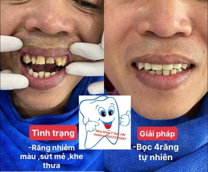 Nha khoa Y Đức Hà Nội