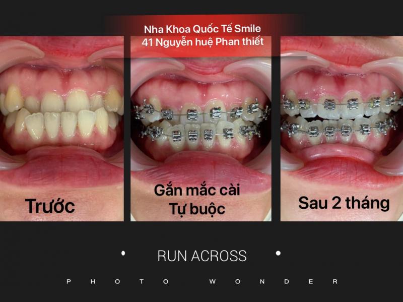 Nha Khoa Quốc Tế Smile