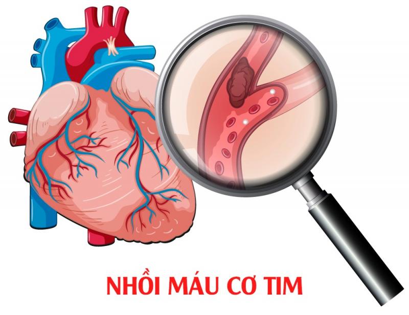 Nhồi máu cơ tim