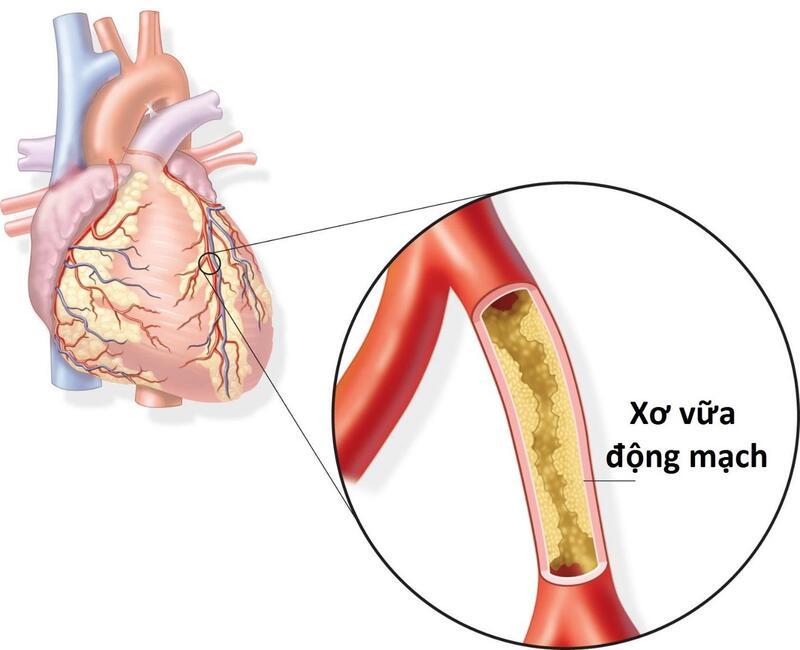 Nhồi máu cơ tim là gì?