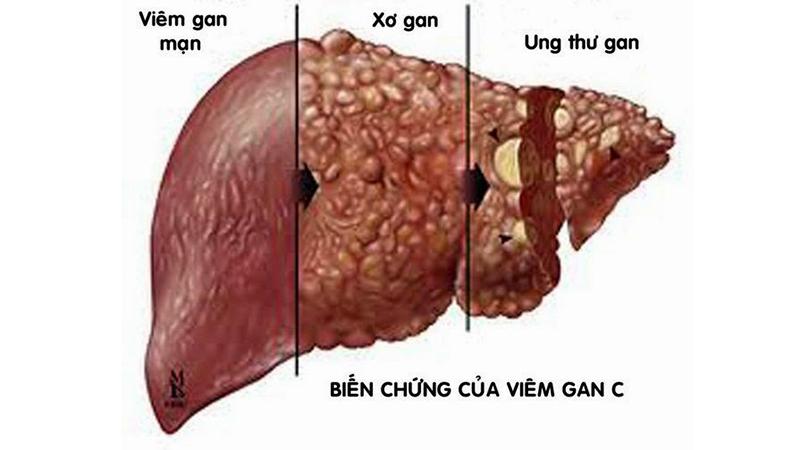 Biến chứng của viêm gan C