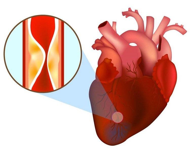 LDL cholesterol tăng cao có thể dẫn đến tình trạng nhồi máu cơ tim
