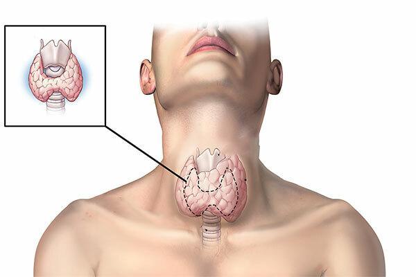 Ung thư tuyến giáp phát triển qua 4 giai đoạn