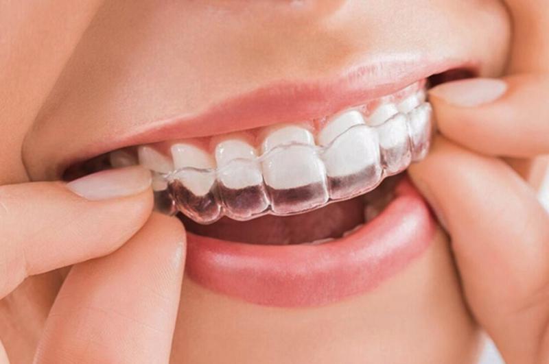 Niềng răng trong suốt Invisalign hoạt động ra sao?