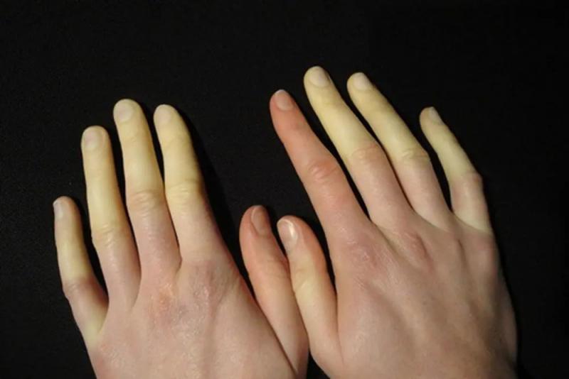 Sản phẩm điều trị triệu chứng của chứng Raynaud