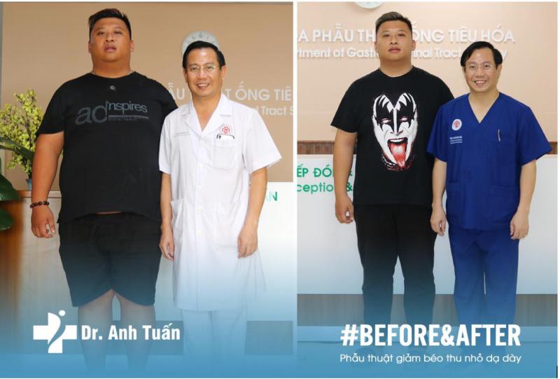 PGS.TS.BS Nguyễn Anh Tuấn cùng bệnh nhân béo phì trước và sau mổ