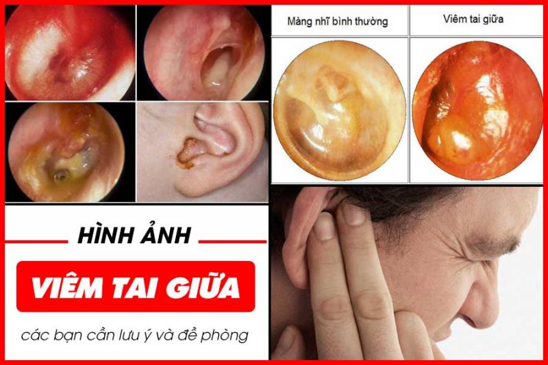 Phân biệt viêm tai ngoài và viêm tai giữa
